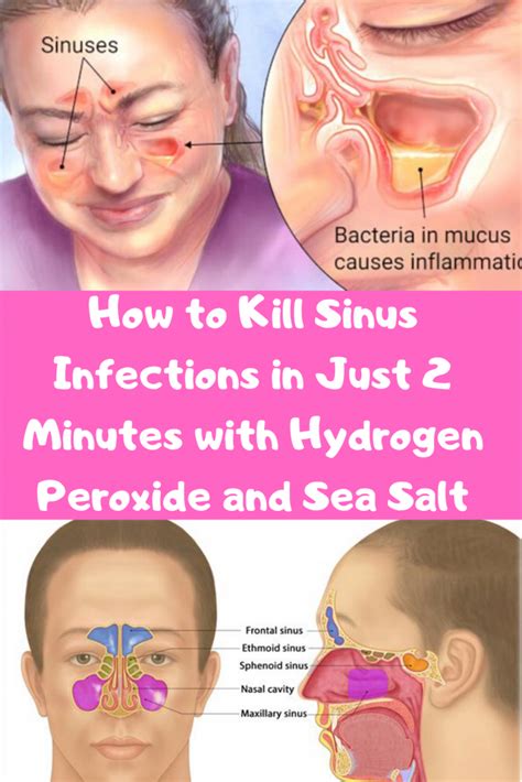 Sphenoid Sinusitis Symptoms Headache - Headache