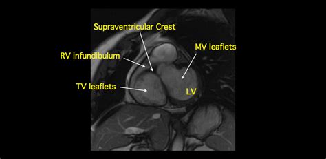 MRI BLOG: Cardiac Anatomy