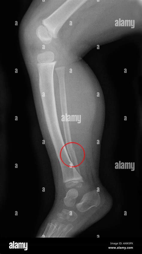 x-ray of an infant showing a fracture of the tibia and fibula of the ...