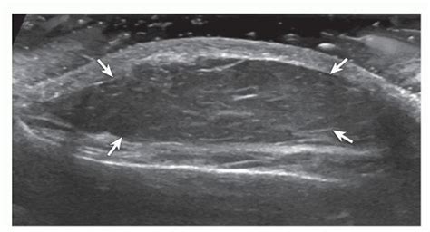 Lipoma. Ultrasound image shows oval hypoechoic subcutaneous lipoma (arrows) with internal linear ...