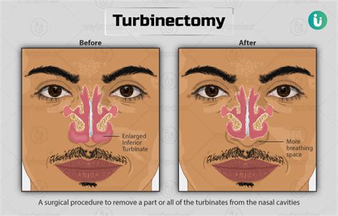 Turbinectomy: Procedure, Purpose, Results, Cost, Price