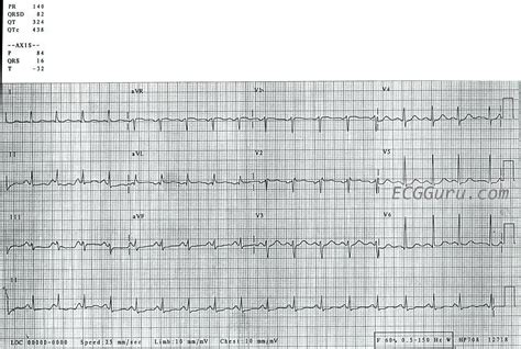 Sinus Tachycardia | ECG Guru - Instructor Resources