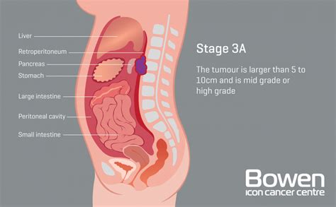 What is Soft Tissue Sarcoma? Soft Tissue Sarcoma Explained — Bowen Icon Cancer Centre