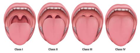 Pediatric Airway Evaluation - OpenAnesthesia