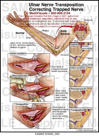 Ulnar nerve Transposition Correcting Trapped Nerve Medivisuals