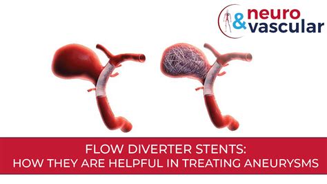 Flow Diverter Stents: How They are helpful in treating aneurysms