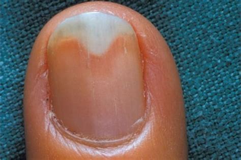 What Is Onycholysis? - Health - NAILS Magazine