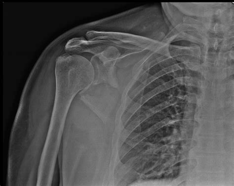 Increased Scapular Spine Fractures After Reverse Shoulder Arthroplasty ...