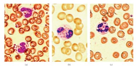 Wright stain of peripheral blood smear of CHS patients, showing ...