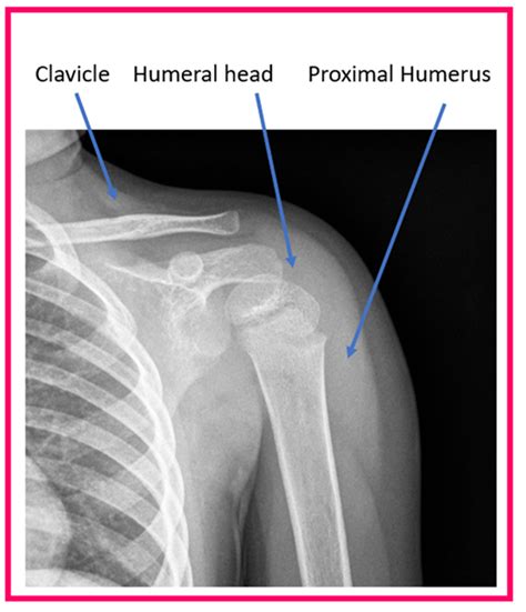 Humerus Bone Fracture Sling Discounted Shop | www.deborahsilvermusic.com