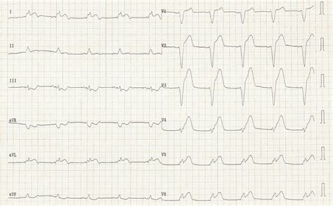 ST elevation myocardial infarction EKG examples - wikidoc