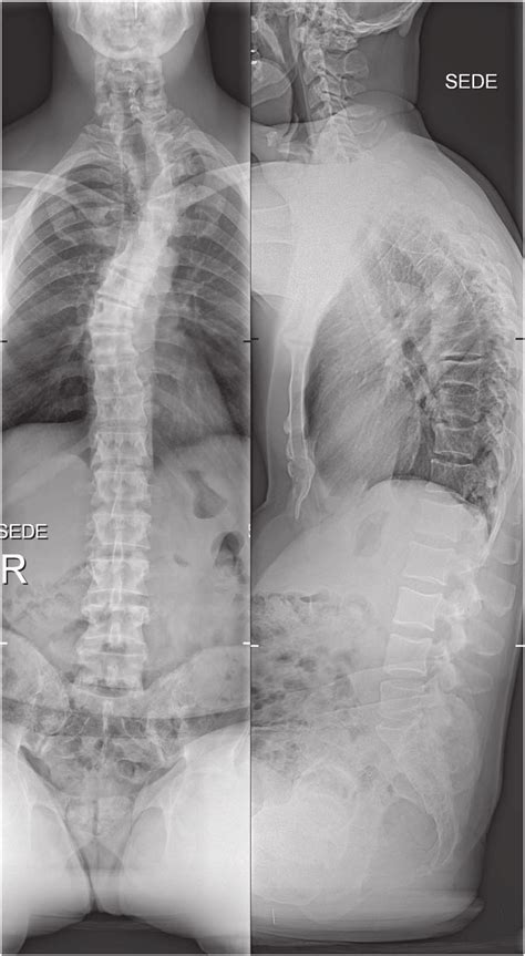 The initial X-ray images of the thoracic spine at the time of admission... | Download Scientific ...