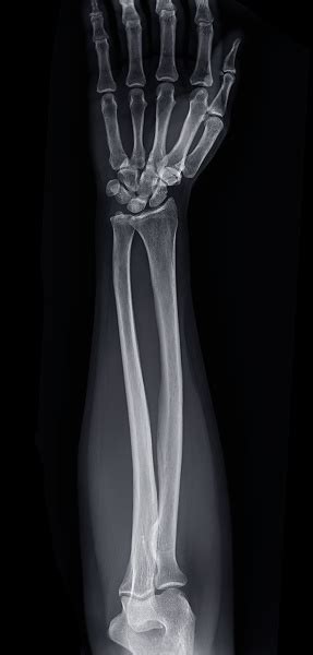 Xray Image Of Forearm Bone Stock Photo - Download Image Now - Bone Fracture, Broken, Forearm ...