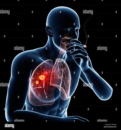 Lung cancer due to smoking, artwork Stock Photo: 65208780 - Alamy