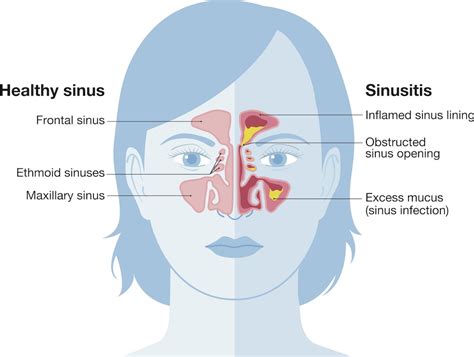 Sinus Infection Symptoms and Treatment Houston TX