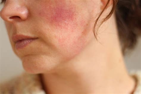 Red Blotches on Face Treatment - Pictures, Causes of Red spots on Face