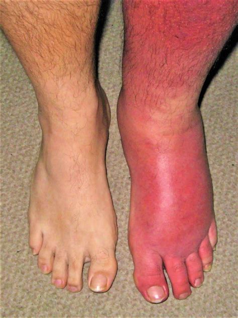 Cellulitis causes, signs, symptoms, diagnosis, prevention and treatment