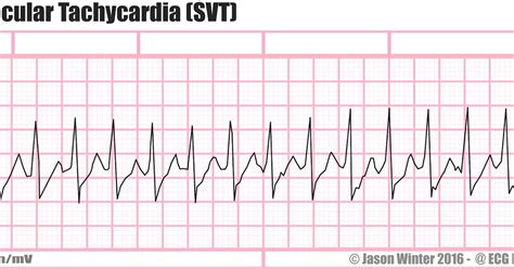 Tachycardia Ecg Supraventricular Ekg Vagal Maneuvers Svt Grepmed Porn | Hot Sex Picture