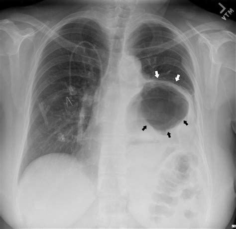 “A Large Hiatal Hernia”: Atypical Presentation of Gastric Volvulus ...