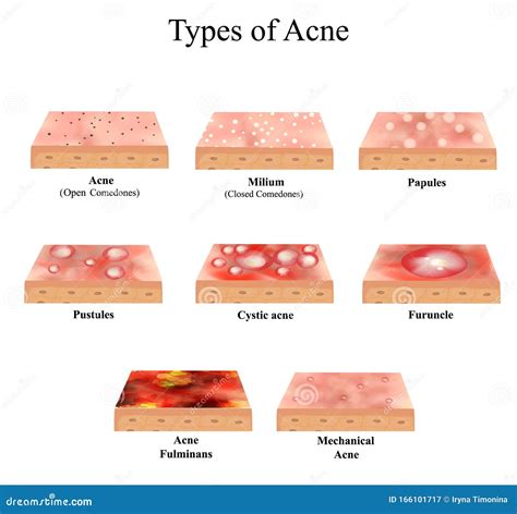 Types of Acne Skin Inflammation. Pimples, Boils, Whitehead, Closed Comedones, Papules, Pustules ...