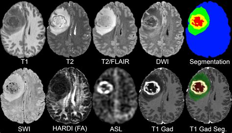 The University of California San Francisco Preoperative Diffuse Glioma MRI (UCSF-PDGM) - The ...