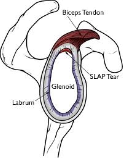 Posterior Labral tears and SLAP tears - Adam Watson Orthopaedic Surgeon