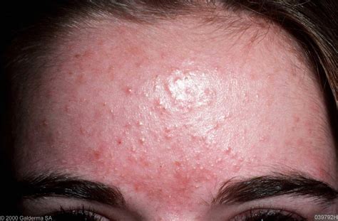 folliculitis Archives - Envision Skin Care Center | PoreInfusion Acne Care Products