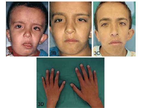 A. Frontal photograph of the patient with Goldenhar syndrome before... | Download Scientific Diagram