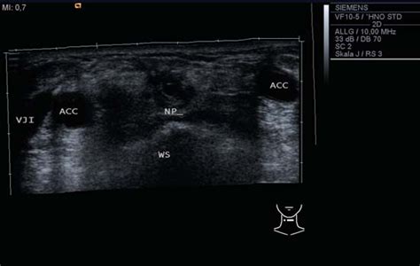 Neck Lymph Nodes | Radiology Key