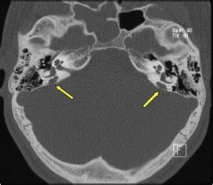 Cabinet Messidor, Bruxelles Uccle | Tympanoplasty - Gusher as a complication in otosclerosis ...