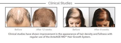 AnteAGE Home Hair System | Healthy Hair Growth