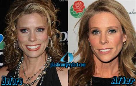 Cheryl Hines Plastic Surgery Before After Defends