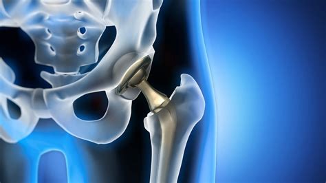 The Partial Hip Replacement Recovery Timeline - Orange County Orthopedic Center