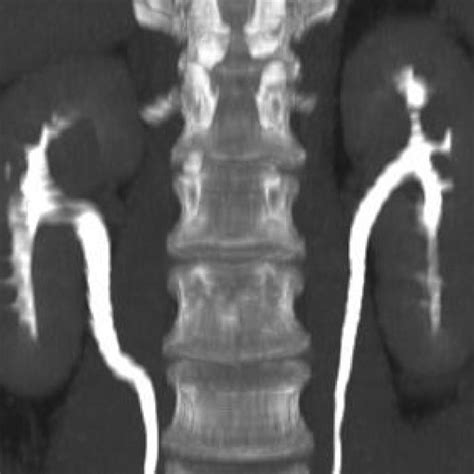 Left renal tumor. (A) Intravenous urography show a filling defect at... | Download Scientific ...