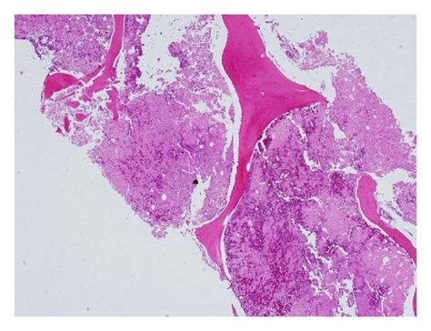 (a) Bone marrow aspirate showing necrotic cells with very rare intact... | Download Scientific ...