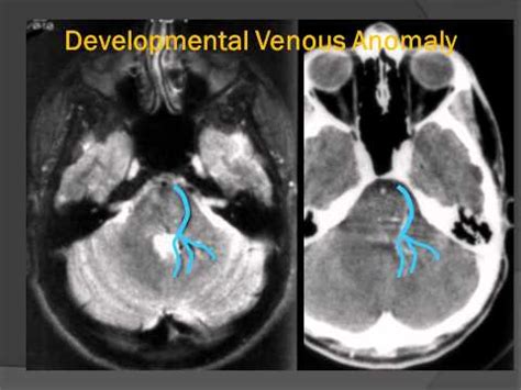 Developmental venous abnormalities - Zvirwere - 2023