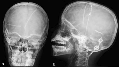 Skull X-Ray showing two ventriculoperitoneal shunt systems. AP and ...