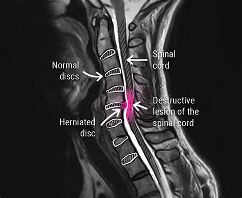 Cervical Disc Herniation - CCV Montpellier