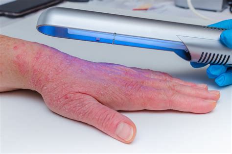 Long-Term Phototherapy for Vitiligo Associated With Reduced Risk for Heart Disease, Stroke ...