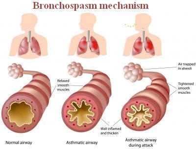 Bronchospasm: Definition, Symptoms, Causes, and Treatment