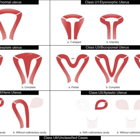 Arcuate uterus in a 17-year-old girl with right-lower-quadrant pain ...