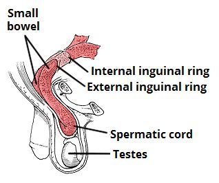 Inguinal Hernia - Classification - Management - TeachMeSurgery