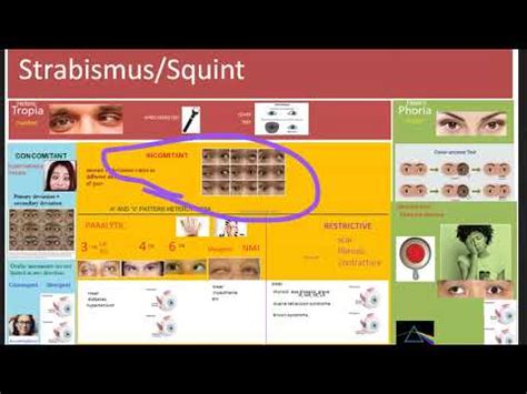 Ophthalmology 352 Strabismus Squint Difference Heterotropia Heterophoria define classification ...