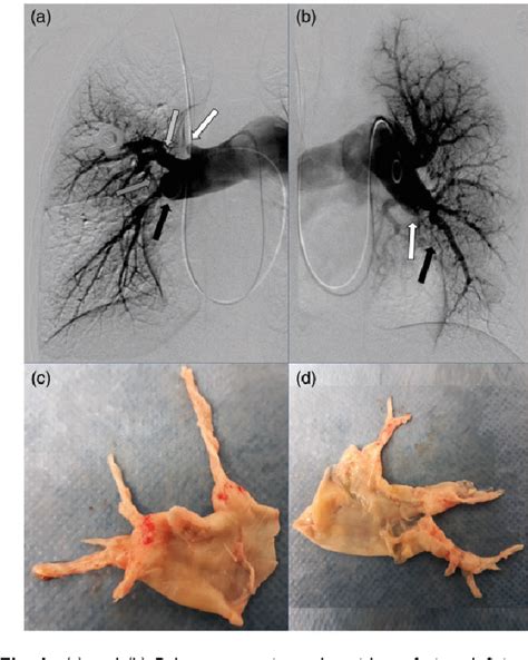 Figure 1 from Pulmonary endarterectomy in a 12-year-old boy with multiple comorbidities ...