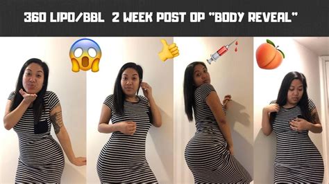 2 WEEK POST OP BBL | 360 Lipo | BODY REVEAL | Elite Plastic Surgery ...