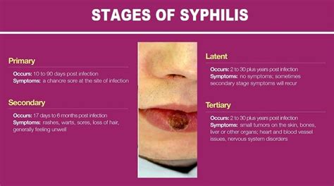 Syphilis Infection, Symptoms and Stages - Helal Medical