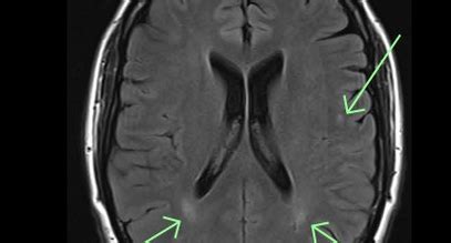 White Matter Hyperintensities on MRI: What Do They Signify?