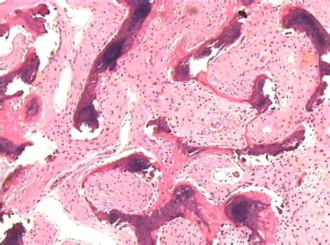 The histology of fibrous dysplasia reveals fibroblasts, collagen, and ...