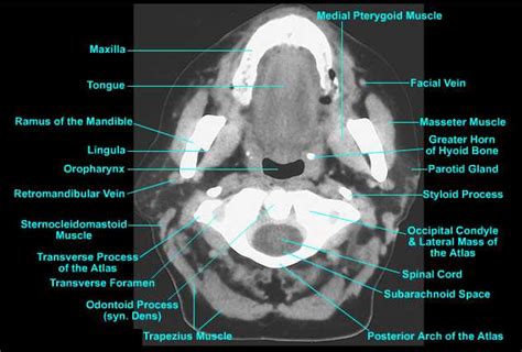 Ct Neck Anatomy - Anatomical Charts & Posters