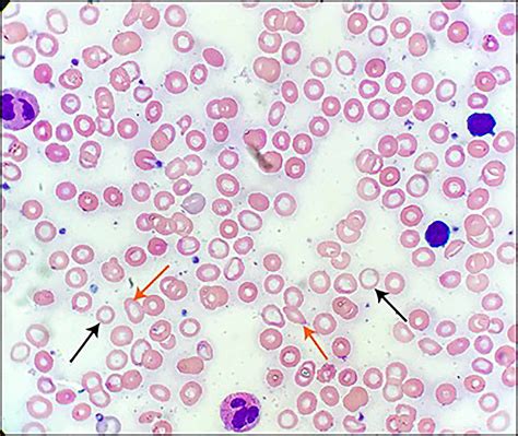 Cureus | Zinc Deficiency-induced Hypogeusia in a Patient with Refractory Iron-deficiency Anemia ...